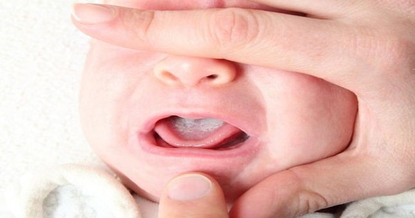 علاج فطريات اللسان عند حديثي الولادة ماميتو