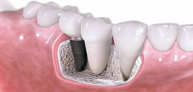 جسر الاسنان الانواع والفوائد والتكلفة تجميلي